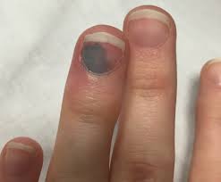 Blood under nail case study